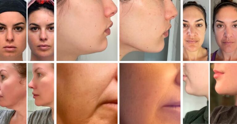 Results before after gua sha facial massage